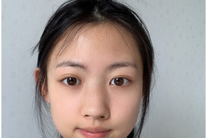 昆明吳氏嘉美美容醫(yī)院李明整形價格表附鼻修復(fù)案例展示