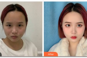 云南華美美萊美容醫(yī)院宋萍整形價格表附激光美膚案例展示