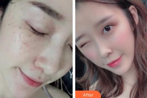 上海美立方整形醫(yī)院王守軍整形價格表附超激光美膚+祛斑針展示