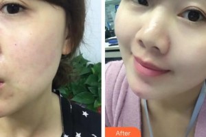 上海港華醫(yī)院浦東分院（悅?cè)葆t(yī)療美容診所）穆雄錚整形價格表附果酸煥膚案例展示