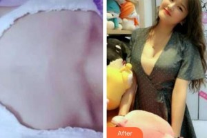 上海解放軍第八五醫(yī)院整形美容科顧海峰整形價格表附隆胸案例展示