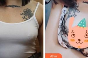 上海解放軍第八五醫(yī)院整形美容科倪俊整形價格表附假體隆胸案例展示