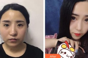 上海解放軍第四五五醫(yī)院激光整形科黃佰乾麻醉科副主任 整形價格表附眼部手術(shù)案例展示