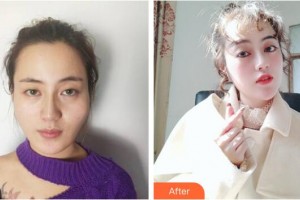 成都春天醫(yī)療美容門診部廖建春整形價格表附面部輪廓案例展示