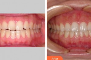 上海天大醫(yī)療美容醫(yī)院張群整形價格表附牙齒正畸案例展示