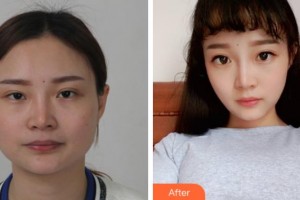 上海解放軍第四五五醫(yī)院激光整形科宣慶元 整形價格表附DA·頜面整形案例展示