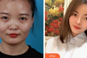 上海解放軍第四五五醫(yī)院激光整形科歸來整形價格表附臉型（顴骨+下頜角）+鼻部手術(shù)案例展示