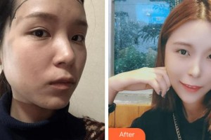 上海華美醫(yī)療美容醫(yī)院袁玉坤整形價格表附女性發(fā)際線種植案例展示