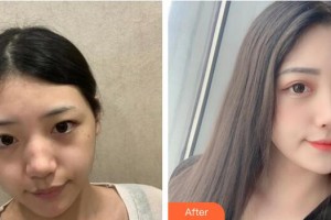 廣州現(xiàn)代醫(yī)院數(shù)字化整形美容中心廖曉蕓整形價(jià)格表附激光祛斑案例展示