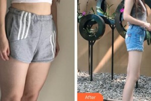 廣州珈禾整形美容門診部李勤整形價(jià)格表附吸脂瘦大腿案例展示