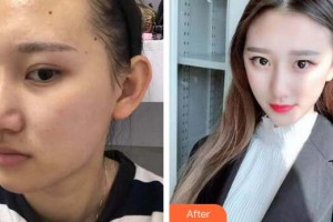 廣州星團(tuán)醫(yī)學(xué)美容門診部廖國善整形價格表附面部吸脂瘦臉案例展示