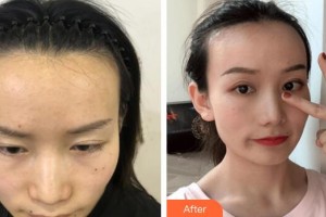 廣州醫(yī)學(xué)院第二附屬醫(yī)院整形美容中心楊志強整形價格表附發(fā)際線種植案例展示