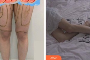 廣州星團(tuán)醫(yī)學(xué)美容門診部顧鵬整形價格表附大腿吸脂案例展示