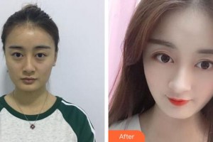 廣州星團(tuán)醫(yī)學(xué)美容門診部劉明整形價格表附假體隆鼻案例展示