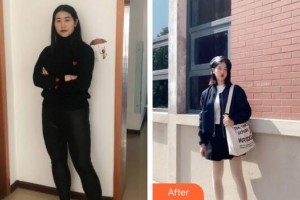 廣州醫(yī)學(xué)院第二附屬醫(yī)院整形美容中心張梅英整形價格表附美體塑形案例展示