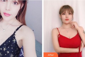 廣州醫(yī)學(xué)院第二附屬醫(yī)院整形美容中心聶冬生整形價格表附假體隆胸案例展示