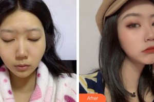 上海仁愛醫(yī)院整形美容科樸宰鉉韓國頭面部整形專家整形價格表附顴骨內(nèi)推案例展示