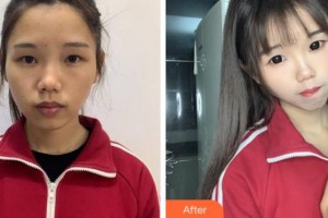 上海仁愛醫(yī)院整形美容科趙軍整形價格表附面部吸脂案例展示