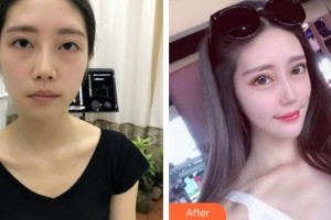 廣州曙光醫(yī)學(xué)美容醫(yī)院蔡方明院長整形價格表附假體下巴案例展示