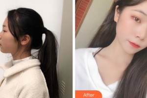 上海仁愛醫(yī)院整形美容科申翰耕韓國“除皺回春”魔術(shù)師整形價格表附光子嫩膚案例展示