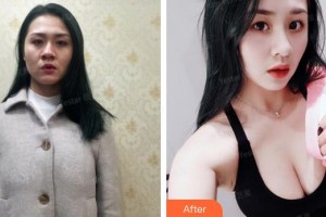 廣州曙光醫(yī)學(xué)美容醫(yī)院劉杰偉整形價格表附假體豐胸案例展示