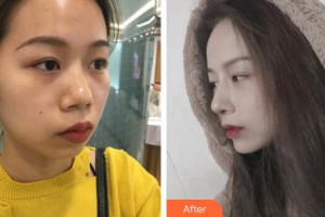 廣州美萊醫(yī)療美容醫(yī)院李逢整形價格表附假體墊下巴案例展示