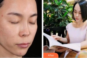 上海仁愛醫(yī)院整形美容科陳峰整形價格表附面部補水祛皺案例展示