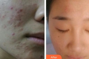 上海仁愛醫(yī)院整形美容科馬艷整形價格表附激光祛痘坑痘印案例展示