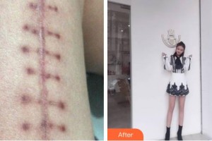 上海天大醫(yī)療美容醫(yī)院孔令義整形價格表附微創(chuàng)疤痕修復案例展示