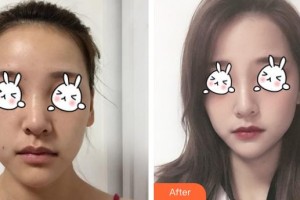 上海天大醫(yī)療美容醫(yī)院王屏整形價格表附無針水光案例展示