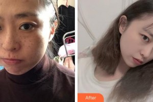 上海天大醫(yī)療美容醫(yī)院朱桂英整形價格表附夢瑤雀斑調節(jié)方案例展示