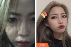 上海時光整形外科醫(yī)院趙克昶整形價格表附果酸煥膚加光子嫩膚案例展示