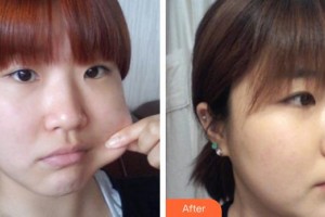 上海時光整形外科醫(yī)院趙紅梅整形價格表附面部吸脂案例展示