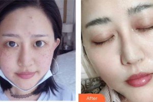 上海時光整形外科醫(yī)院左雯君整形價格表附色斑痘印暗黃出油皺紋案例展示