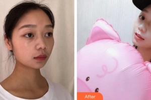 廣州曙光醫(yī)學(xué)美容醫(yī)院劉海峰整形價格表附水氧活膚案例展示