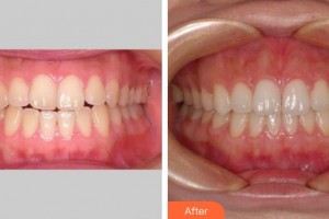 廣州時光整形美容醫(yī)院侯振杰整形價格表附牙齒正畸案例展示