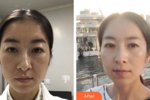 廣州曙光醫(yī)學(xué)美容醫(yī)院單良整形價格表附熱瑪吉案例展示