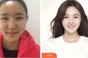 上海宏康醫(yī)院整形美容中心倪芳韻整形價格表附皇后光子嫩膚案例展示