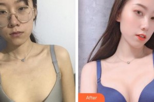 上海美立方整形醫(yī)院李斌整形價格表附濃縮脂肪豐胸案例展示