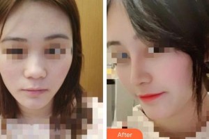 上海滬西醫(yī)院醫(yī)療美容科王春雨整形價格表附膨體+半肋軟骨案例展示