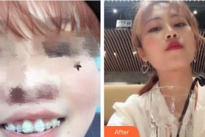 上海滬西醫(yī)院醫(yī)療美容科祖開慧整形價格表附隱形托槽案例展示