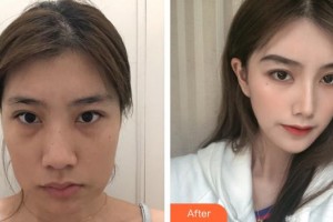 上海萬眾醫(yī)院醫(yī)療美容科文錦花整形價格表附下頜角切除案例展示