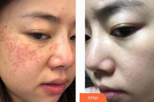 上海美立方整形醫(yī)院馬競整形價(jià)格表附祛斑案例展示