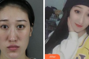 上海美立方整形醫(yī)院洪軍整形價(jià)格表附神奇的雙顎畸形矯正術(shù)案例展示