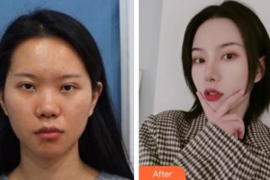 上海二醫(yī)大附屬第九人民醫(yī)院整形激光美容中心崔海燕整形價(jià)格表附假體隆鼻術(shù)案例展示