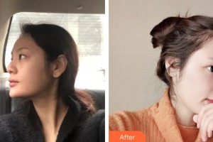 上海華美醫(yī)療美容醫(yī)院李庭勳整形價(jià)格表附鼻部手術(shù)脂肪填充案例展示