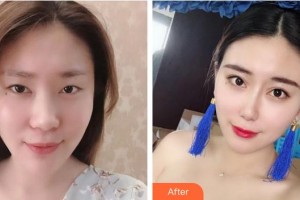 上海華美醫(yī)療美容醫(yī)院文愛克整形價(jià)格表附隆鼻手術(shù)日記案例展示