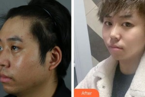 上海首爾麗格醫(yī)療美容醫(yī)院洪性范整形價(jià)格表附下頜角+皮質(zhì)骨+夾脂墊案例展示