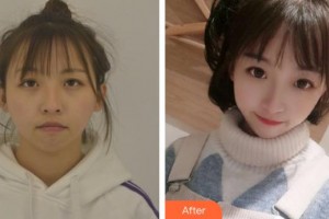 上海諾詩雅醫(yī)療美容醫(yī)院蔡景龍整形價(jià)格表附硅膠墊下巴案例展示