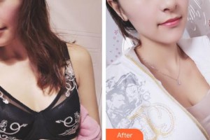 上海港華醫(yī)院浦東分院（悅?cè)葆t(yī)療美容診所）陳華生整形價(jià)格表附濃縮脂肪豐胸案例展示